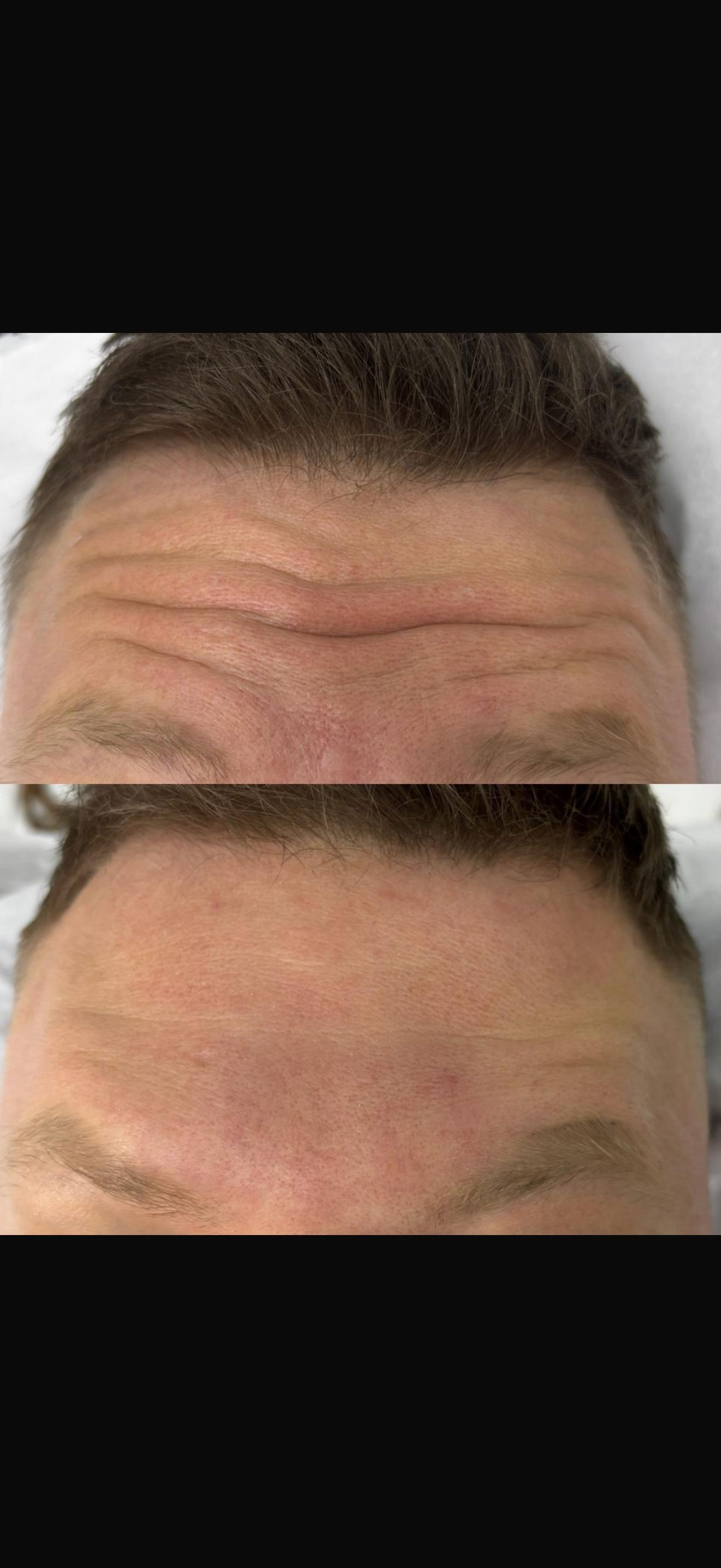 Anti-wrinkle treatment — forehead lines softened, before & after
