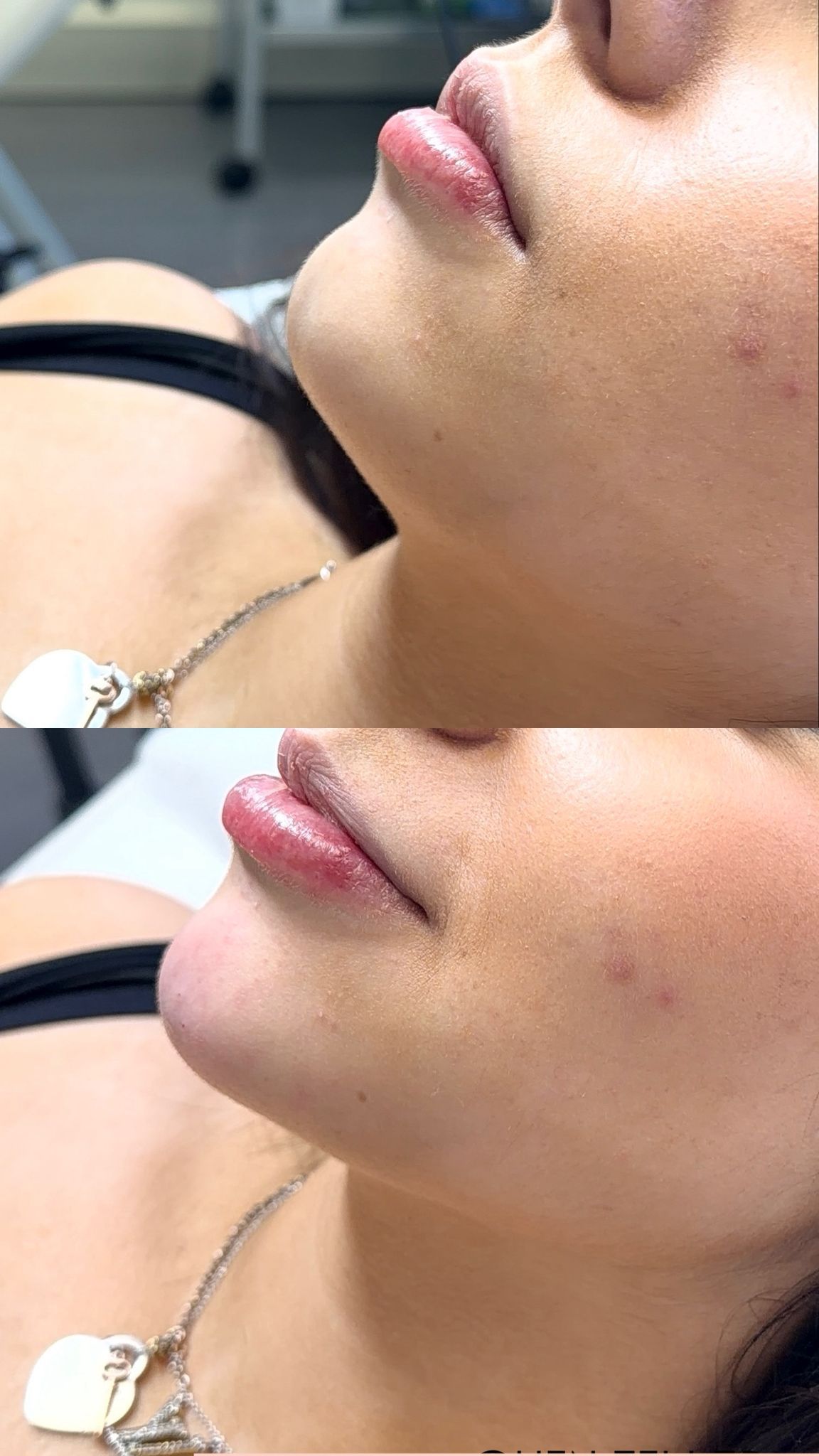 Chin augmentation with dermal filler — refined profile, before & after