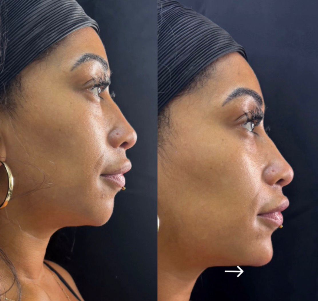 Dermal filler face sculpting — refined chin & jawline