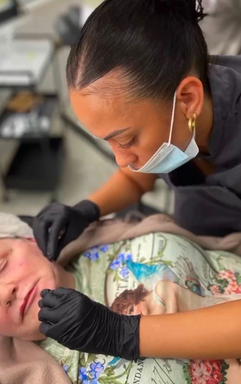 Jawline augmentation using cannula technique