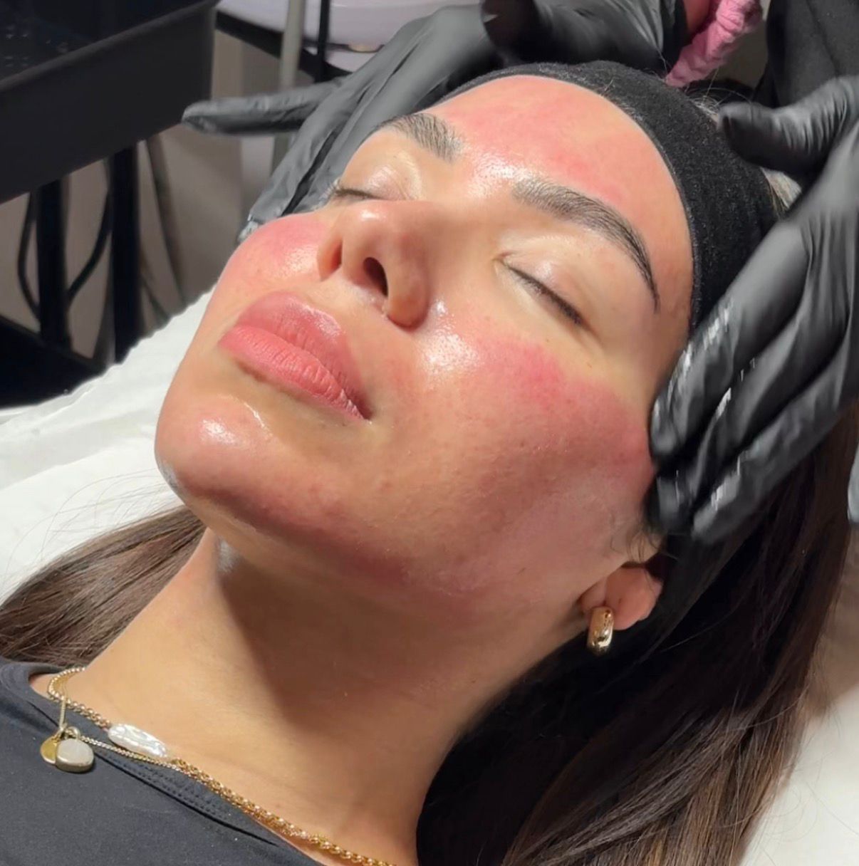 Microneedling — immediately post-treatment glow